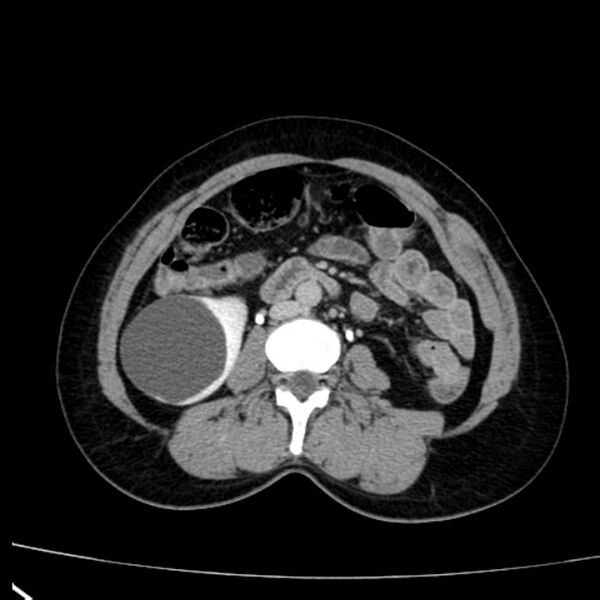 File:Bosniak renal cyst - type I (Radiopaedia 27479-27675 D 27).jpg