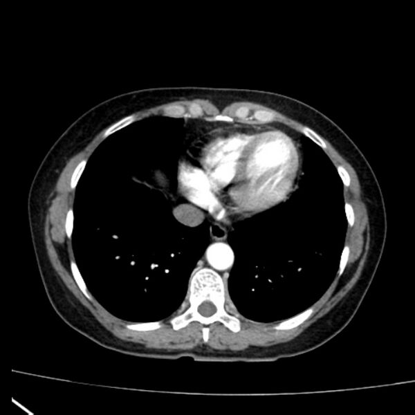 File:Bosniak renal cyst - type I (Radiopaedia 27479-27675 renal cortical phase 2).jpg