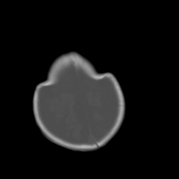 File:Brachycephaly (bi-coronal and bi-lambdoid synostosis) (Radiopaedia 55048-61413 Axial bone window 23).jpg