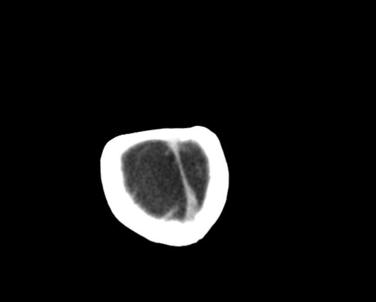 File:Brachycephaly (bi-coronal and bi-lambdoid synostosis) (Radiopaedia 55048-61413 Axial non-contrast 53).jpg