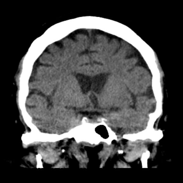 File:Brain cortical laminar necrosis (Radiopaedia 25822-25971 C 23).jpg