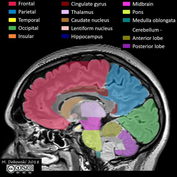 File:Brain lobes - annotated MRI (Radiopaedia 61691-69700 Sagittal 45).JPG