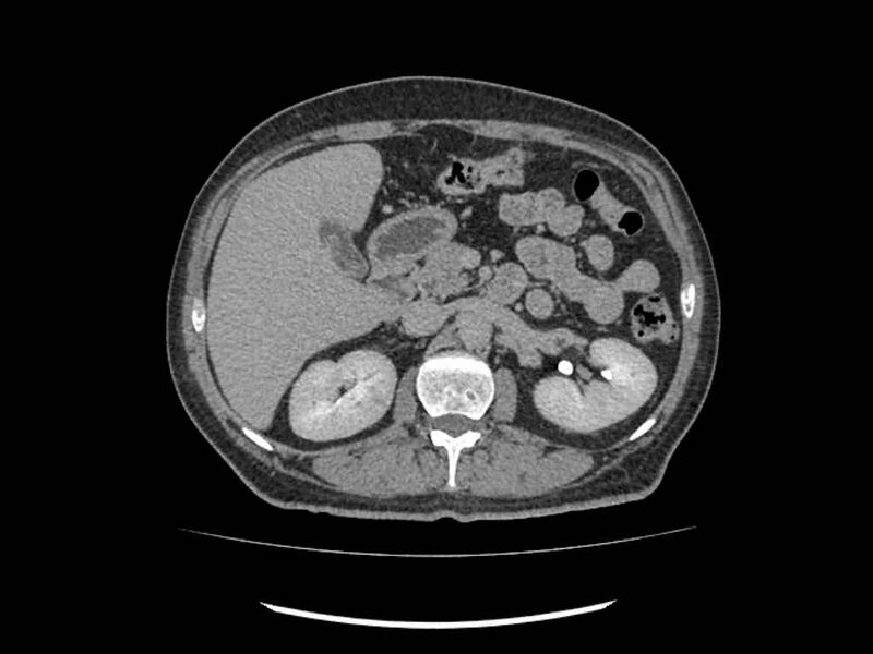 File:Brain metastases from renal cell carcinoma (Radiopaedia 42222-45328 Axial C+ delayed 71).jpg