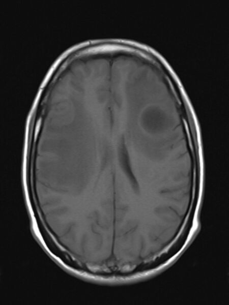 File:Brain metastasis as initial presentation of non-small cell lung cancer (Radiopaedia 65122-74126 Axial T1 13).jpg