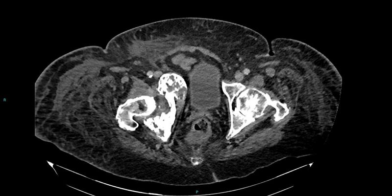 File:Breast cancer pelvic bony metastases (Radiopaedia 84470-99824 Axial bone window 60).jpg