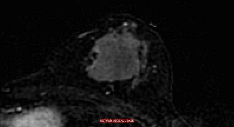 File:Breast lymphoma (MRI) (Radiopaedia 34999-36498 C 6).jpg