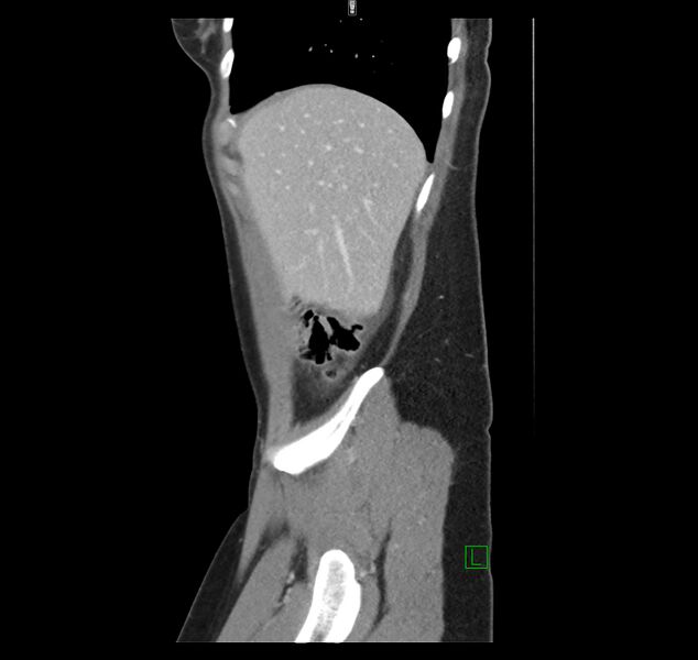 File:Broad ligament hernia (Radiopaedia 63260-71832 C 9).jpg