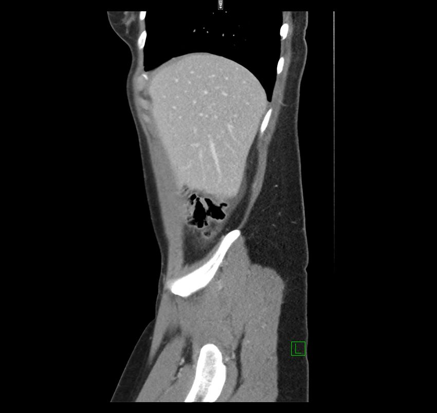 Broad ligament hernia (Radiopaedia 63260-71832 C 9).jpg