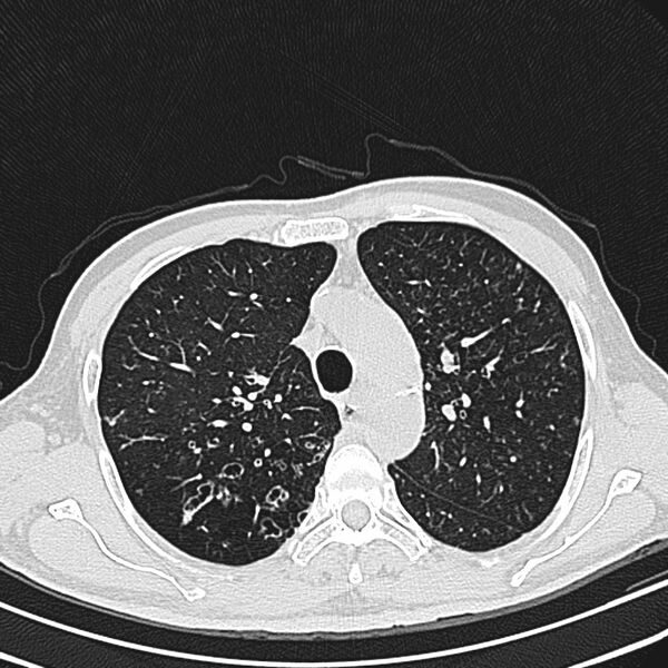 File:Bronchiectasis (Radiopaedia 22061-22059 lung window 9).jpg
