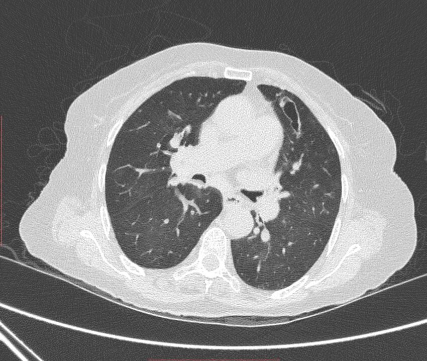 Bronchiectasis (Radiopaedia 72693-83293 Axial lung window 60).jpg
