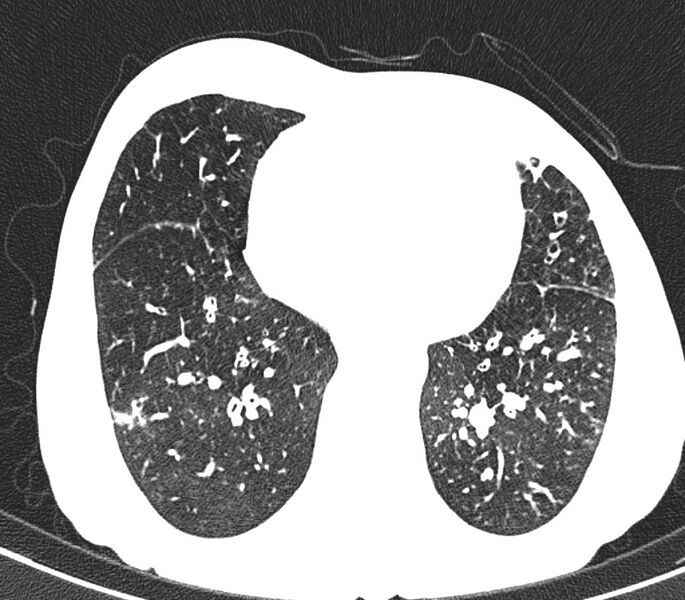 File:Bronchiolitis (Radiopaedia 24616-24887 Axial lung window 42).jpg