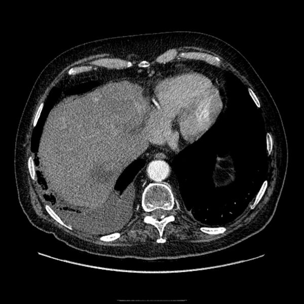 File:Bronchogenic adenocarcinoma and pulmonary embolism (Radiopaedia 9097-9806 D 48).jpg