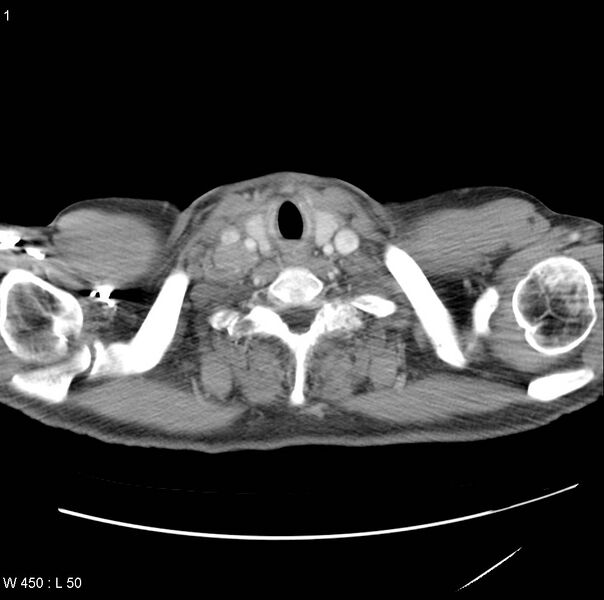 File:Bronchogenic carcinoma (Radiopaedia 8857-9645 A 1).jpg