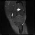 Bucket handle tear - lateral meniscus (Radiopaedia 7246-8187 Coronal T2 fat sat 17).jpg