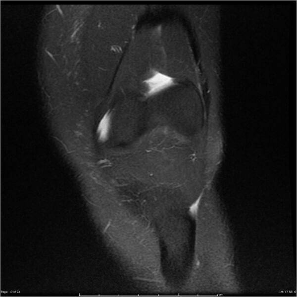 File:Bucket handle tear - lateral meniscus (Radiopaedia 7246-8187 Coronal T2 fat sat 17).jpg