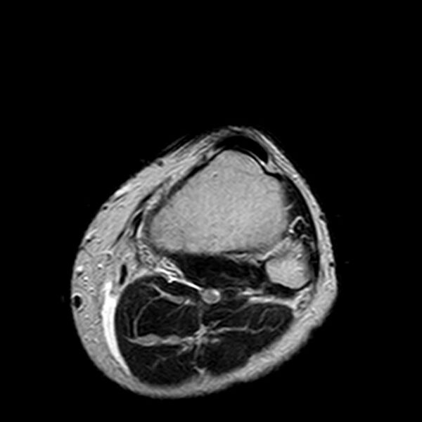 File:Bucket handle tear - medial meniscus (Radiopaedia 29250-29664 Axial T2 1).jpg