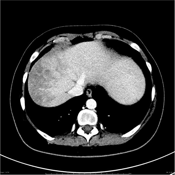File:Budd-Chiari syndrome (Radiopaedia 27929-28177 Axial liver window 7).JPG