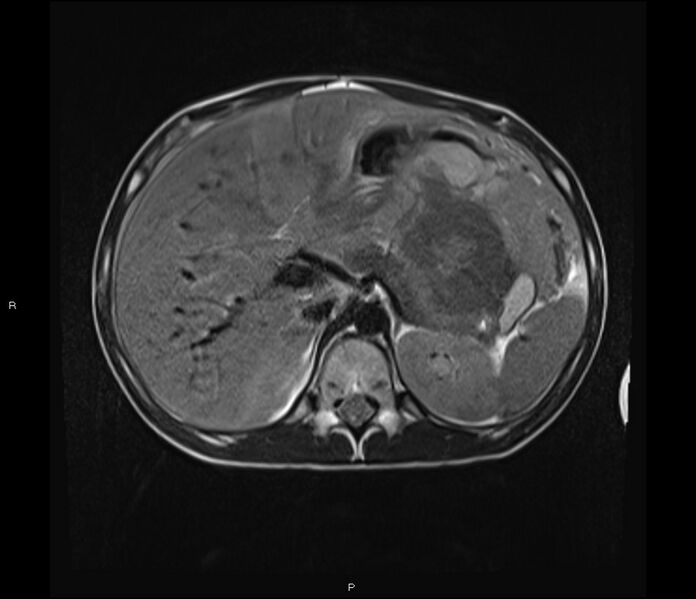 File:Burkitt lymphoma (bowel) (Radiopaedia 68839-78557 Axial T2 17).jpg