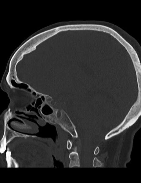 File:Burnt-out meningioma (Radiopaedia 51557-57337 Sagittal bone window 19).jpg