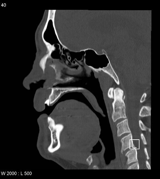 File:Calcification of the transverse band of the cruciform ligament (Radiopaedia 53063-59025 Sagittal bone window 17).jpg