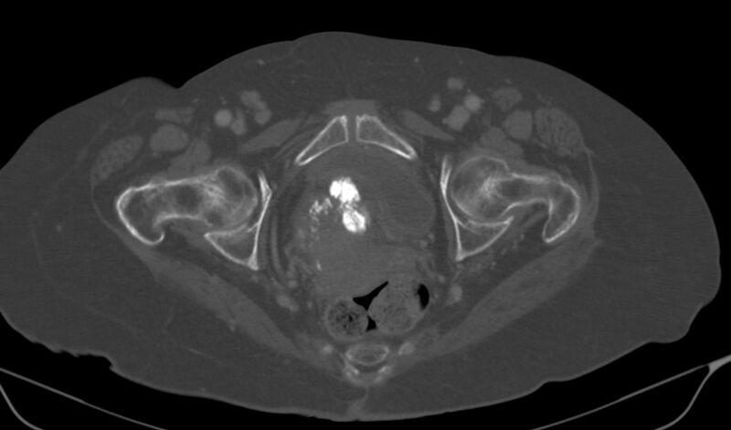 File:Calcified fibroids (Radiopaedia 20306-20228 Axial bone window 23).jpg