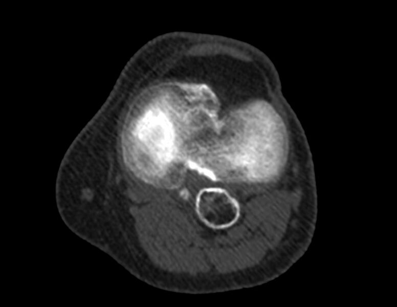 File:Calcified hematoma - popliteal fossa (Radiopaedia 63938-72763 Axial bone window 32).jpg