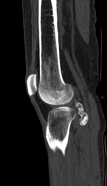 File:Calcified hematoma - popliteal fossa (Radiopaedia 63938-72763 Sagittal bone window 87).jpg