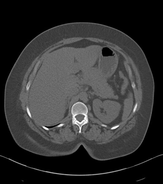 File:Calcified hepatic hydatid cyst (Radiopaedia 81127-94738 Axial non-contrast 30).jpg