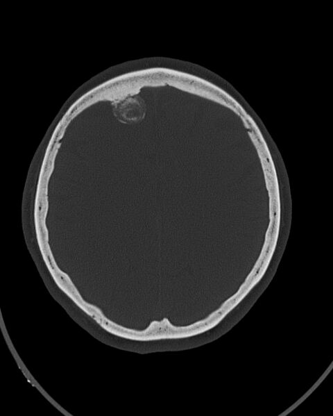 File:Calcified meningioma (Radiopaedia 74361-85243 Axial bone window 14).jpg