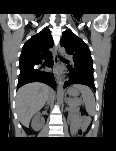 File:Calcifying pulmonary metastases (Radiopaedia 33359-34396 Coronal non-contrast 21).jpg