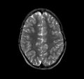 Callosal dysgenesis and ectopic posterior pituitary (Radiopaedia 8382-9213 Axial T2 1).jpg