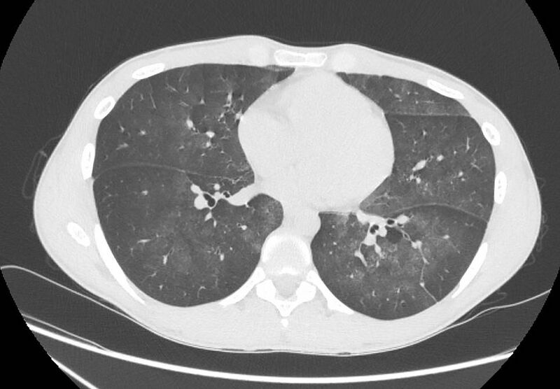 File:Cannabis-induced diffuse alveolar hemorrhage (Radiopaedia 89834-106946 Axial lung window 70).jpg