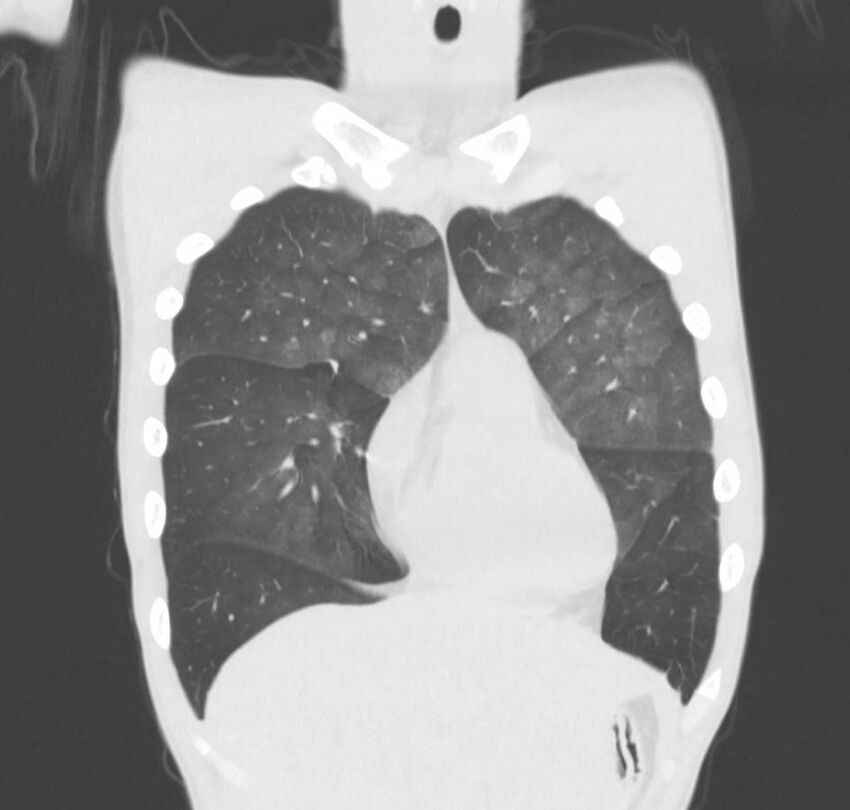 Cannabis-induced diffuse alveolar hemorrhage (Radiopaedia 89834-106946 Coronal lung window 68).jpg