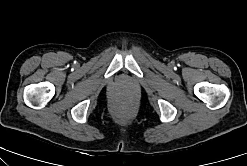 File:Carcinoid mesenteric tumor complicated by chylous ascites (Radiopaedia 76312-88926 A 82).jpg