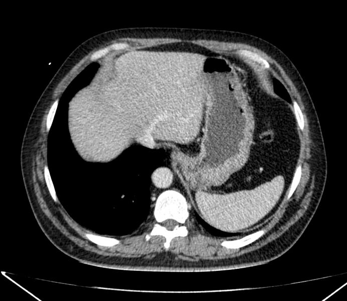 File:Carcinoid tumor with hepatic metastases (Radiopaedia 22651-22670 C 30).jpg