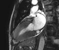 Cardiac amyloidosis (Radiopaedia 39736-42124 B 10).jpg