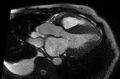 Cardiac amyloidosis (Radiopaedia 61600-69579 B 22).jpg