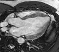 Cardiac sarcoidosis (Radiopaedia 39811-42243 LVOT cine images 21).jpg