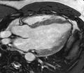 Cardiac sarcoidosis (Radiopaedia 39811-42243 LVOT cine images 23).jpg