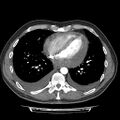 Cardiac tamponade (Radiopaedia 78607-91368 Axial C+ CTPA 60).jpg