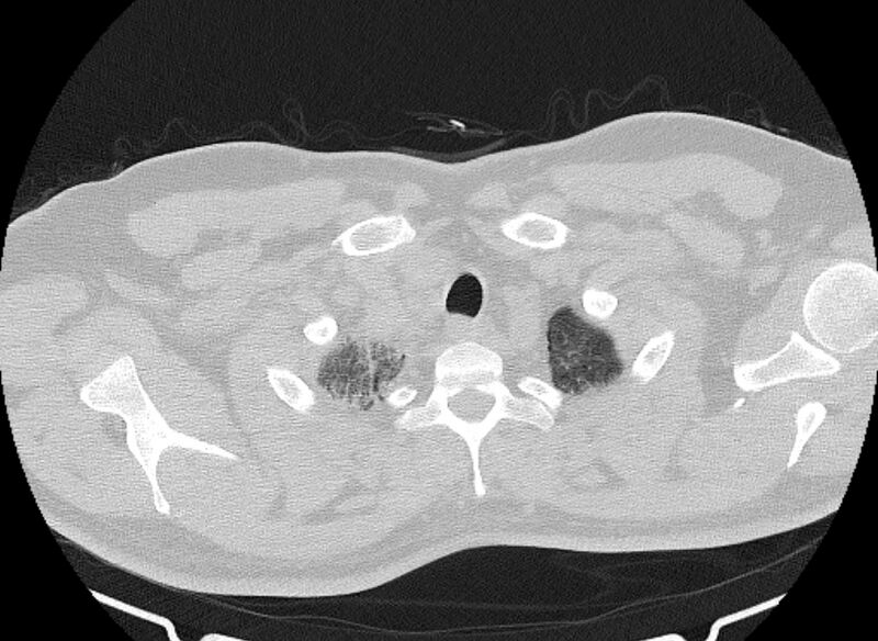File:Cardiogenic pulmonary edema (Radiopaedia 68180-77678 Axial lung window 2).jpg