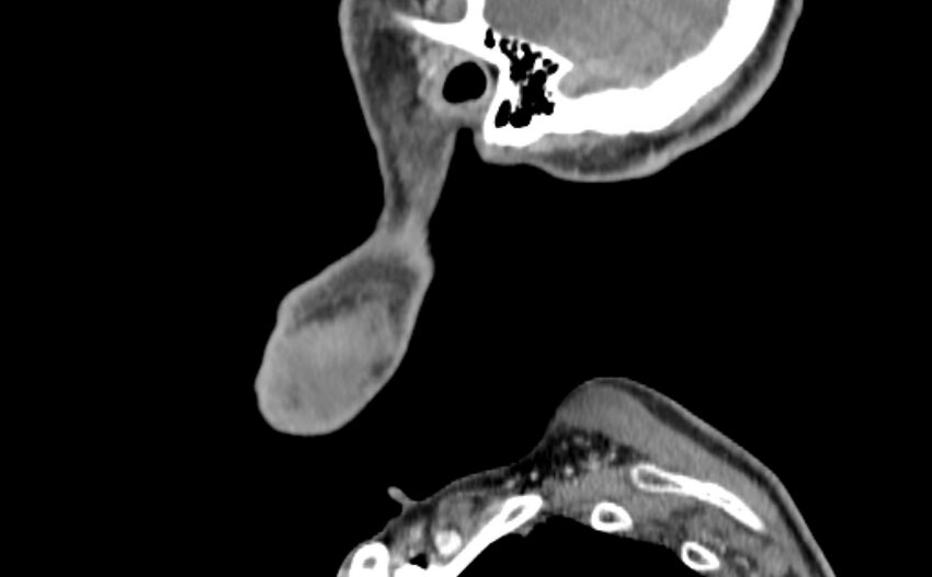 Carotid artery pseudoaneurysm (Radiopaedia 84030-99259 E 64).jpg