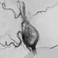 Carotid body tumor on angiography (Radiopaedia 4651-6729 A 3).jpg