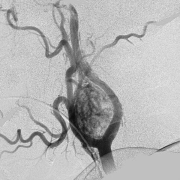File:Carotid body tumor on angiography (Radiopaedia 4651-6729 A 3).jpg