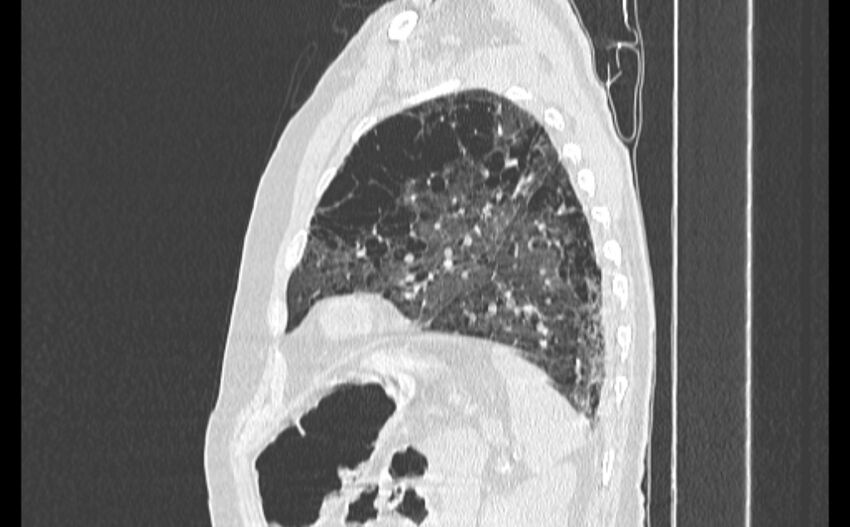Cavitating bronchogenic carcinoma (Radiopaedia 44489-48162 Sagittal lung window 52).jpg