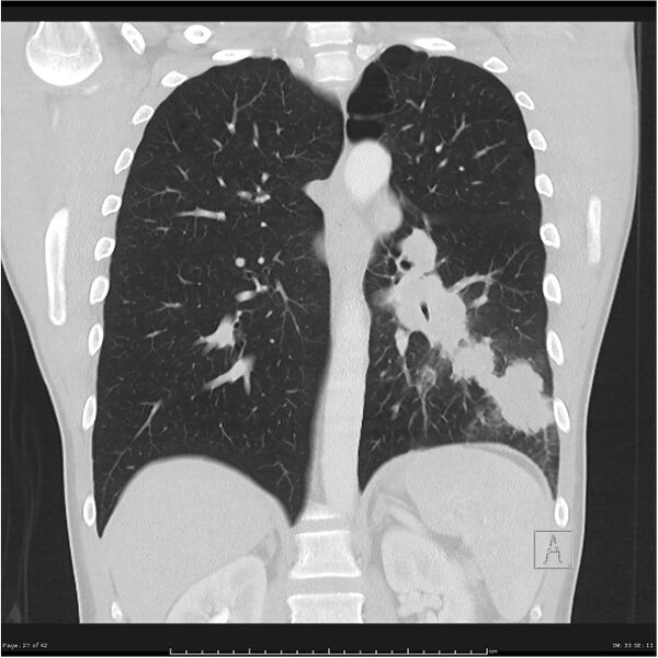 File:Cavitating lung cancer (Radiopaedia 25796-25945 lung window 27).jpg