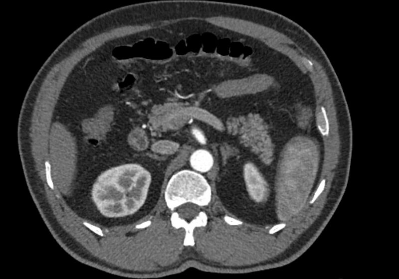 File:Celiac artery dissection (Radiopaedia 52194-58080 A 33).jpg