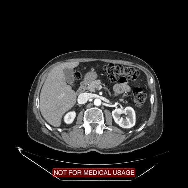 File:Celiac trunk variant anatomy - gastrohepatic trunk and splenic artery (Radiopaedia 38815-40995 A 41).jpg
