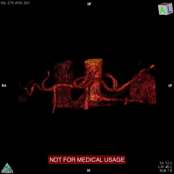 File:Celiac trunk variant anatomy - gastrohepatic trunk and splenic artery (Radiopaedia 38815-40995 B 17).jpg