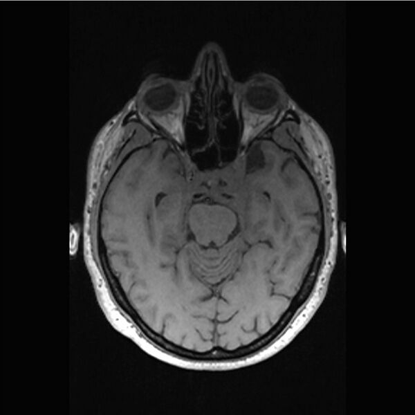 File:Central base of skull meningioma (Radiopaedia 53531-59549 Axial T1 17).jpg